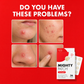 Parche hidrocoloide para imperfecciones - 75unid